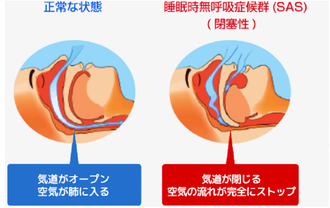 睡眠時無呼吸症候群